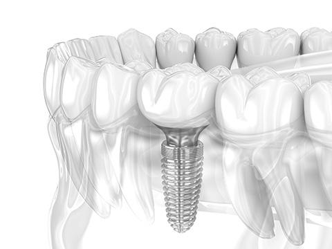 Service Implant